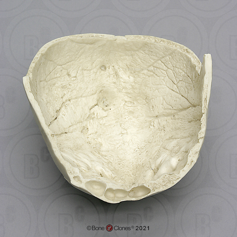 Human Calvarium with hyperostosis frontalis interna