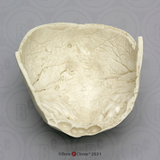 Human Calvarium with hyperostosis frontalis interna