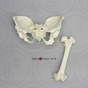 Human Female Achondroplasia Dwarf Pelvis and Femur Set Human Female Achondroplasia Dwarf Pelvis and Femur Set