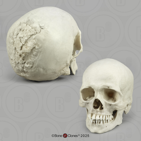 Human Skull, Syphilis Human Skull, Syphilis