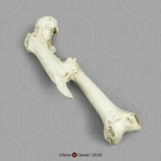 Human Right Femur Fracture with Malunion Human Right Femur Fracture with Malunion