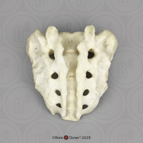 Human Sacrum with Spina Bifida Human Sacrum with Spina Bifida