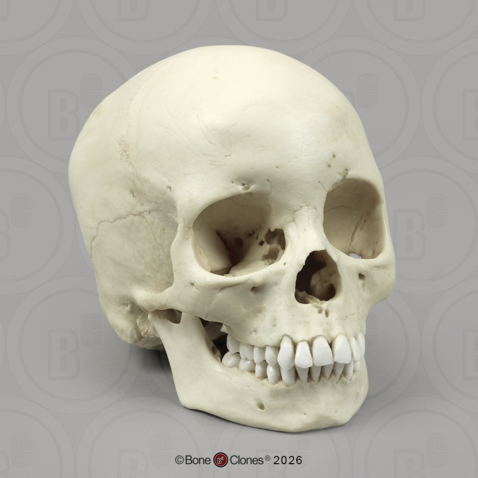 Human Skull with Porotic Hyperostosis and Cribra Orbitalia
