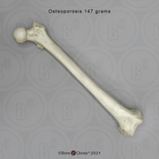 Human Adult Female Femur, Osteoporosis Human Adult Female Femur, Osteoporosis